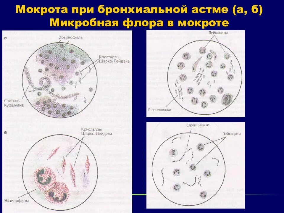 Анализ мокроты при астме. Исследование мокроты спирали Куршмана. Спирали Куршмана Кристаллы Шарко- Лейдена при бронхиальной астме. Кристаллы Шарко-Лейдена в мокроте. Спирали Куршмана микроскопия.