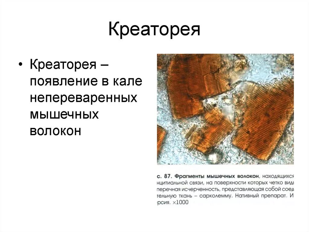 Микроскопия кала растительная клетчатка непереваримая. Непереваренные мышечные волокна в Кале у ребенка. Микроскопия кала переваренные мышечные волокна. Мышечные волокна в Кале микроскопия. Перевариваемая растительная клетчатка в кале у ребенка