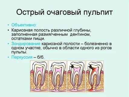 Острый край зуба