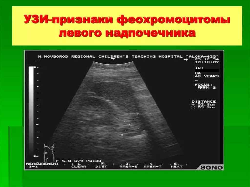 УЗИ надпочечников. Аденома надпочечника по УЗИ. Левый надпочечник на УЗИ. Узи почка не видна