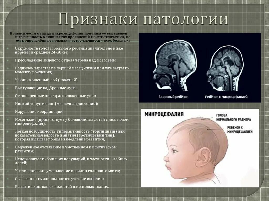 Нарушение развития головного мозга. Микроцефалия головного мозга у новорожденных. Микроцефальная форма головы у грудничка. Морфофункциональная незрелость головного мозга новорожденного это. Череп микроцефальной формы.