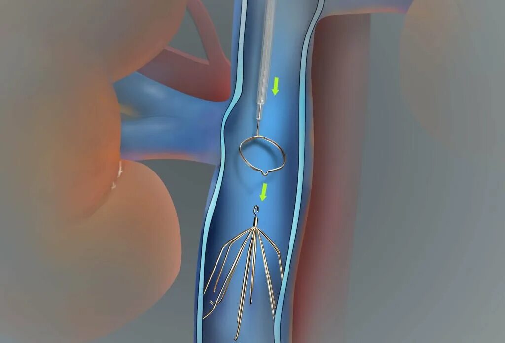 Кава фильтр в нижней полой Вене. Реолитическая катетерная тромбэктомия. Эндоваскулярная аспирационная тромбэктомия. Чрескожная аспирационная тромбэктомия. Тромбоз тэла