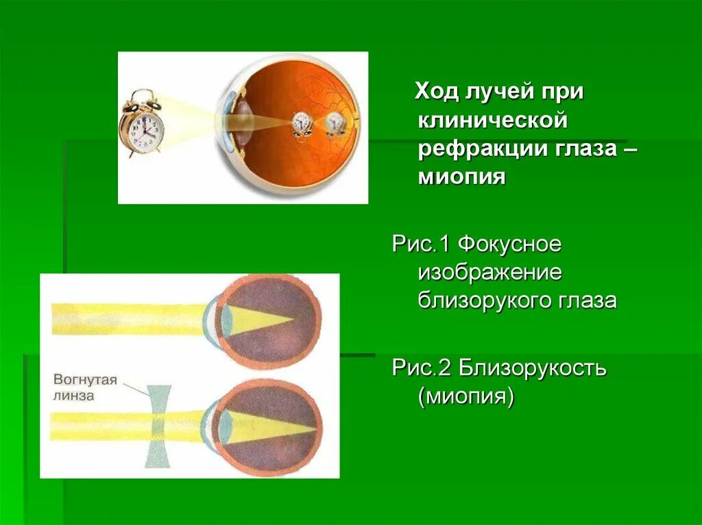 Дополните предложения изображение в близоруком