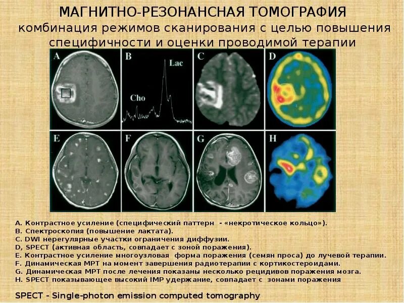 Как проявляется рак мозга. Диагностические критерии глиомы головного мозга. объемное образование головного мозга диагноз. локализация опухолей головного мозга.