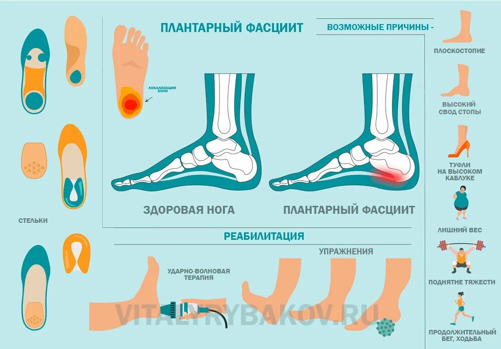 Плантарный фасциит шпора. Плантарный фасциит стопы. Плантарный фасциит (подошвенный фасциит). Увт плантарный фасциит. Двусторонний плантарный фасциит.