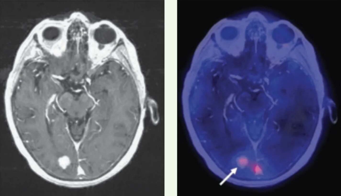 ПЭТ кт опухоли головного мозга. Метастатическое поражение головного мозга кт. Метастазы головного мозга кт. На кт видно опухоль
