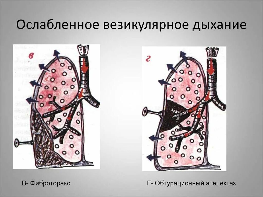 Везикулярное дыхание. Ослабленное везикулярное дыхание при. Дыхание вещикулярное ослаблено. Нормальное везикулярное дыхание.