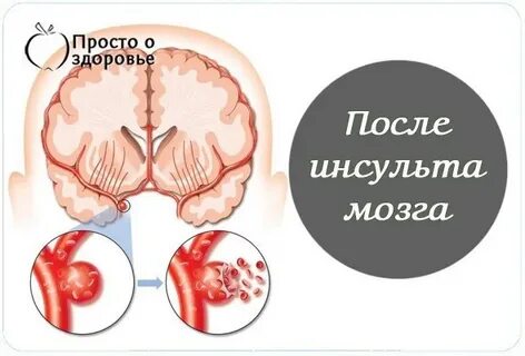 Как получить группу после инсульта