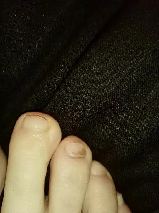 Почему пальцы темные. Темное пятно на ногте ноги. Темное пятнышко на ногте. Коричневое пятно на пальце ноги.
