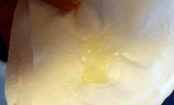 Выделение из молочных желез форум