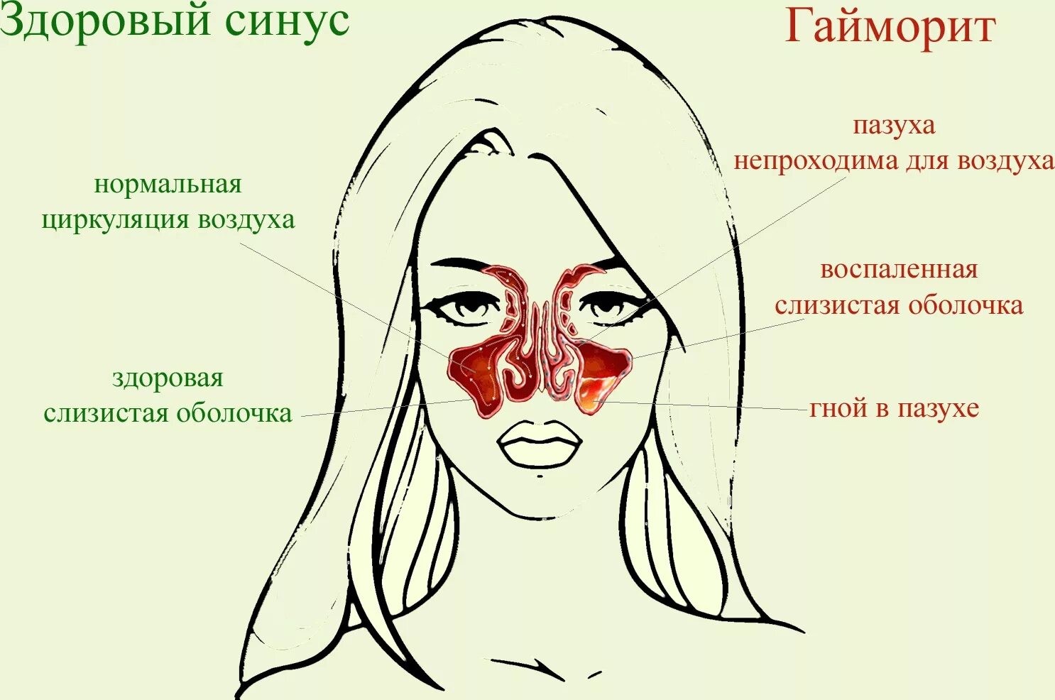 Температура заложенность носа слабость головная боль. Строение носа при насморке.