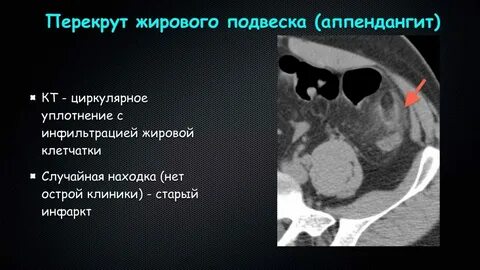 Перекрут подвесок кишки