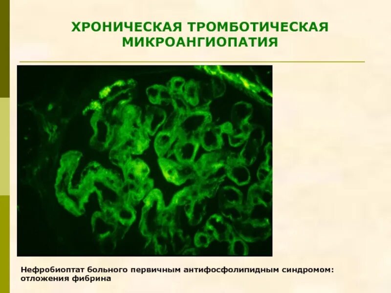 Микроангиопатия что это значит. Тромботическая микроангиопатия. микроангиопатия почек. тромботическая микроангиопатия гистология. тромботическая микроангиопатия почек.