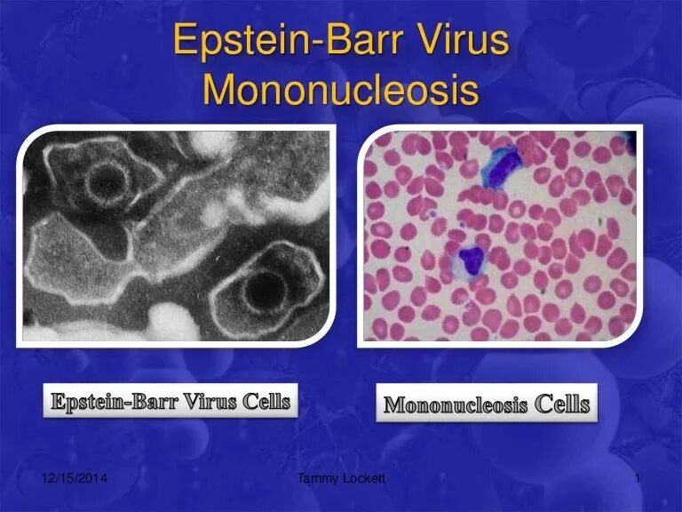 Вэб вирус Эпштейна Барр. Вирус Эпштейна-Барр под микроскопом. Вирус Эпштейна Барра под микроскопом. Мононуклеоз Эпштейна-Барр. Вирус epstein barr virus