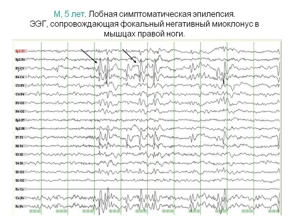 Ээг ответ. Эпилептические паттерны на ЭЭГ. ЭЭГ при эпилепсии расшифровка у детей. Фокальная эпилепсия на ЭЭГ. ЭЭГ при эпилептическом припадке.