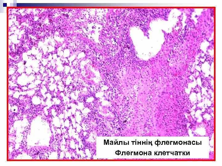 Аппендицит патанатомия. Флегмона мягких тканей микропрепарат. Флегмона кожи микропрепарат. Флегмона подкожной жировой клетчатки микропрепарат. Флегмона подкожной клетчатки микропрепарат.