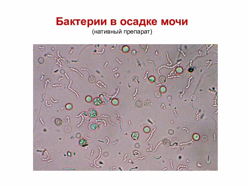 Микроскопия нативного препарата. Бактерии в моче. бактерии в моче микроскопия. микроскопия осадка мочи бактерии. бактерии в микроскопе мочи.