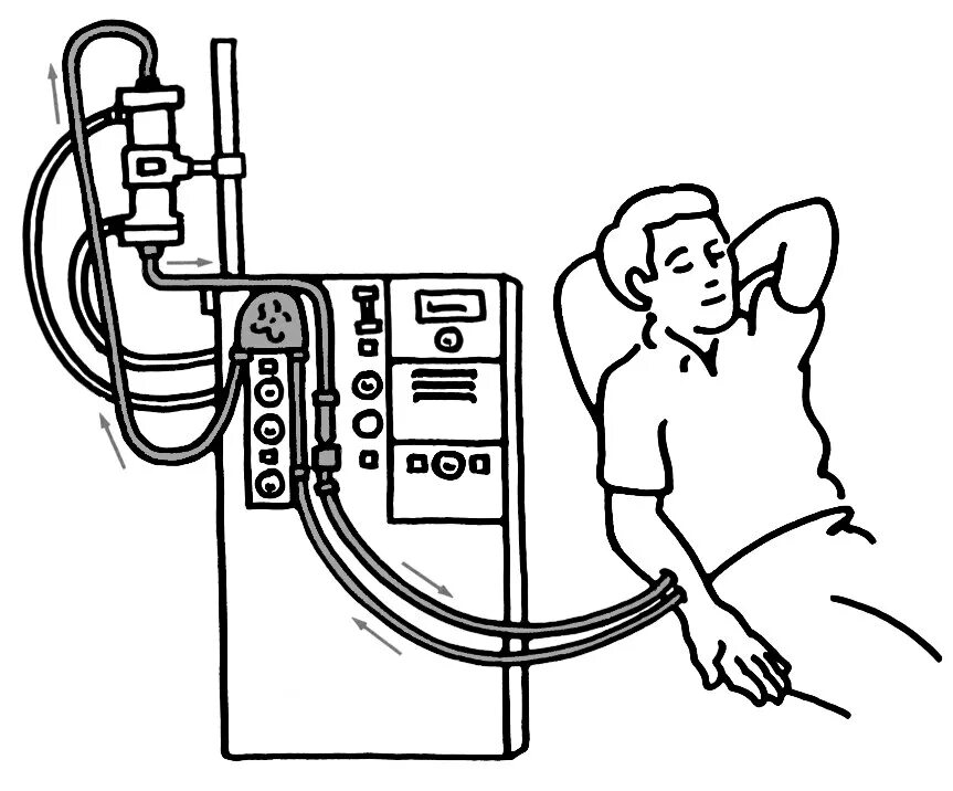 Диализ белков. Гемодиализ схема. Диализ рисунок. Диализ схема. Аппарат диализа рисунок.