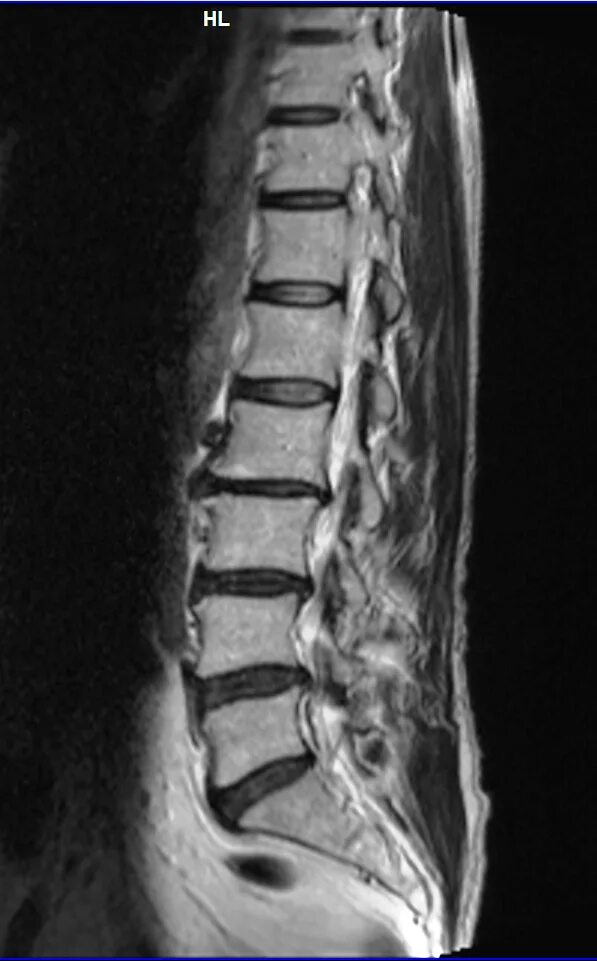 Протрузия диска на уровне l5 s1. Протрузия поясничного отдела л2-с2. Протрузии дисков с4-5. Протрузия диска l4-l5 3 мм циркулярная. Грыжи поясничного отдела 0.9 см.