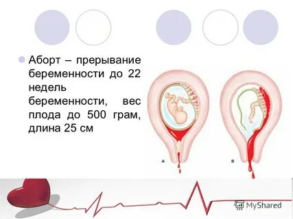 Вероятность выкидыша