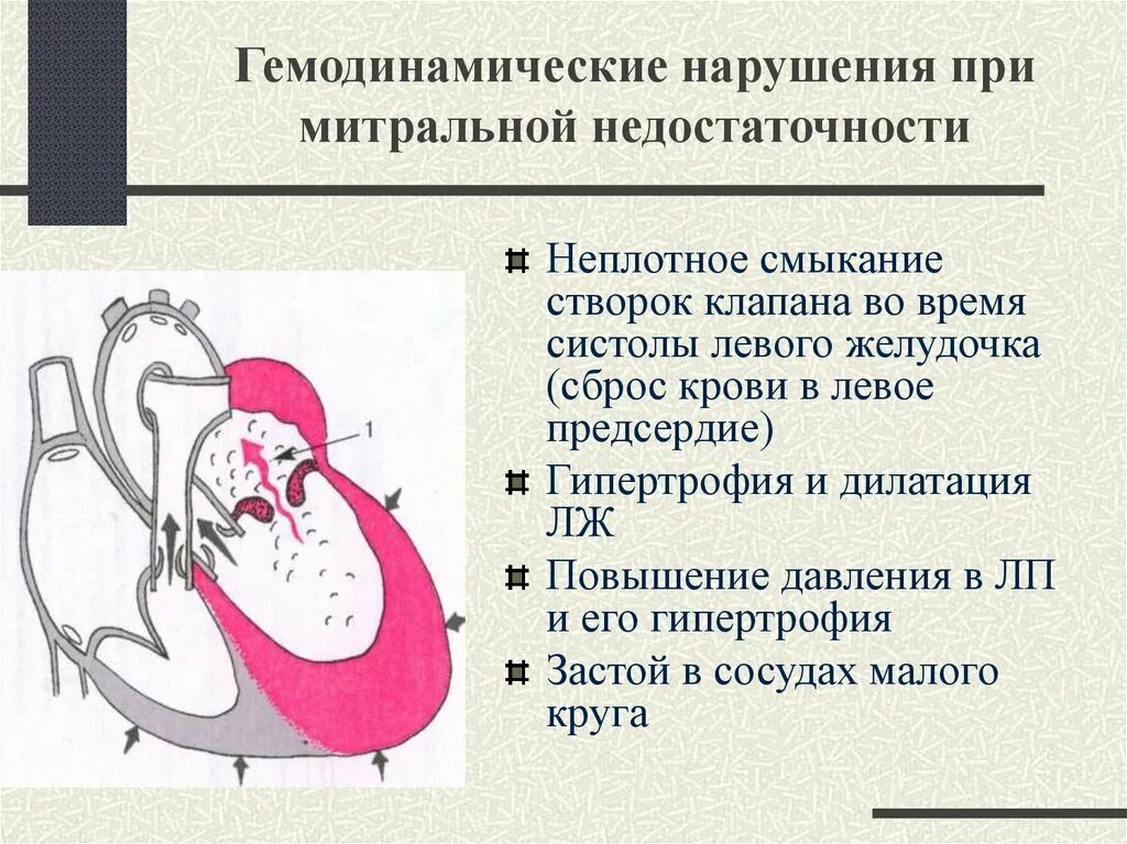 Гипертрофия и дилатация правого желудочка. Гипертрофия и дилатация левого желудочка. Дилятация полости левого желудочка. Тоногенная дилатация левого желудочка. Дилатация сердца схема.
