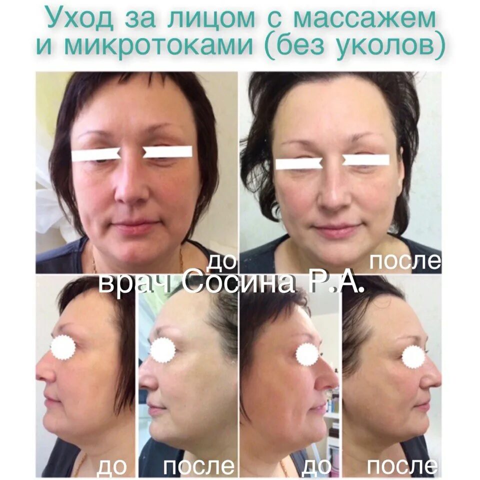 Микротоки лицо до и после фото отзывы. Микротоки до и после. микротоковая терапия для лица фото до и после.