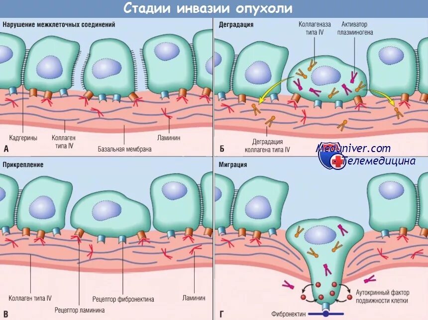 Инвазия опухолевых клеток. Механизмы инвазии опухоли. Стадии инвазии опухоли. Инвазия раковой клетки.