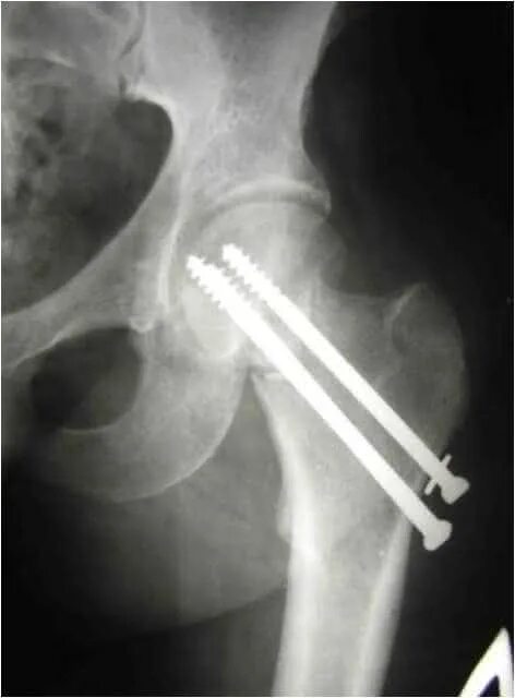 Последствия перелома шейки бедра. Перелом шейки бедра у пожилых. Перелом шейки бедра фиксация. Перелом шейки бедра операция.