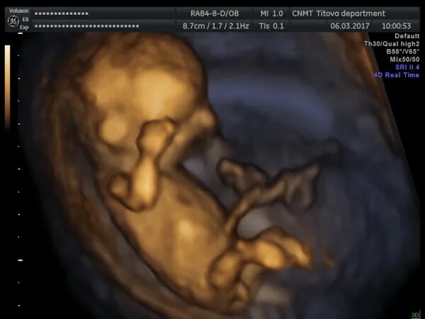 Ultrasound At 13 Weeks Pregnant - photos and vectors