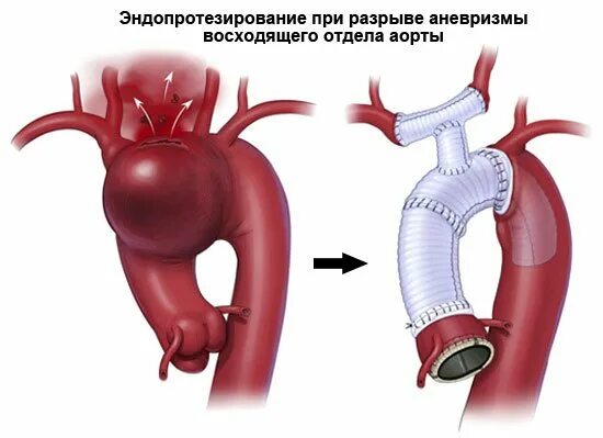 Аневризма восходящего отдела аорты операция. Разрыв аневризмы аорты сердца. Хирургия аневризма восходящего отдела аорты. Супракоронарное протезирование аорты. Аневризма восходящей аорты операция