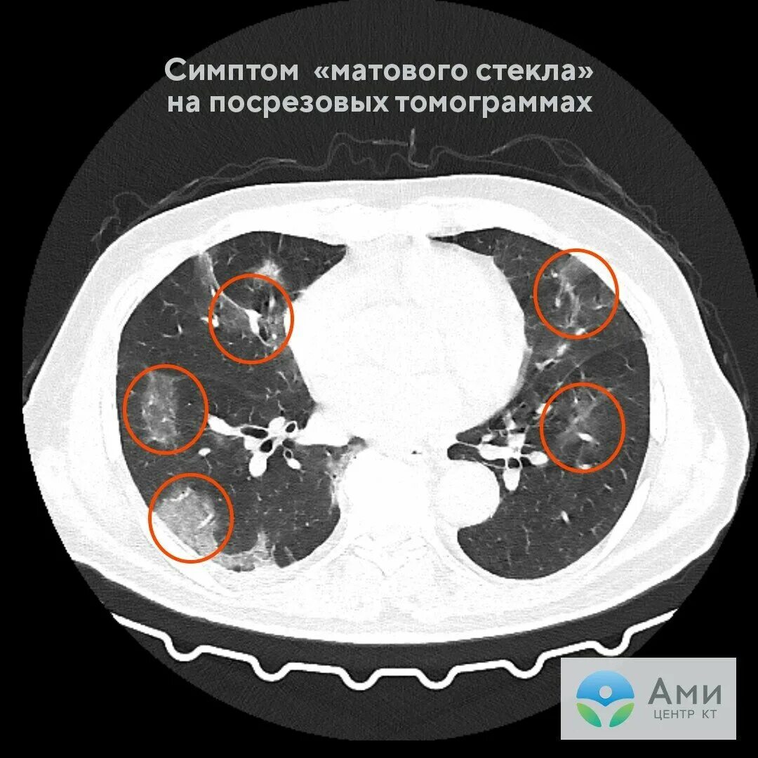 Пневмония при коронавирусе на кт. Коронавирусная пневмония на кт. Пневмония на кт. Кт легких.