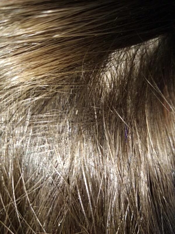 Как отличить гнид. Как отличить гнид. Как отличить гнид. Как отличить гнид. Вычесывание вшей.