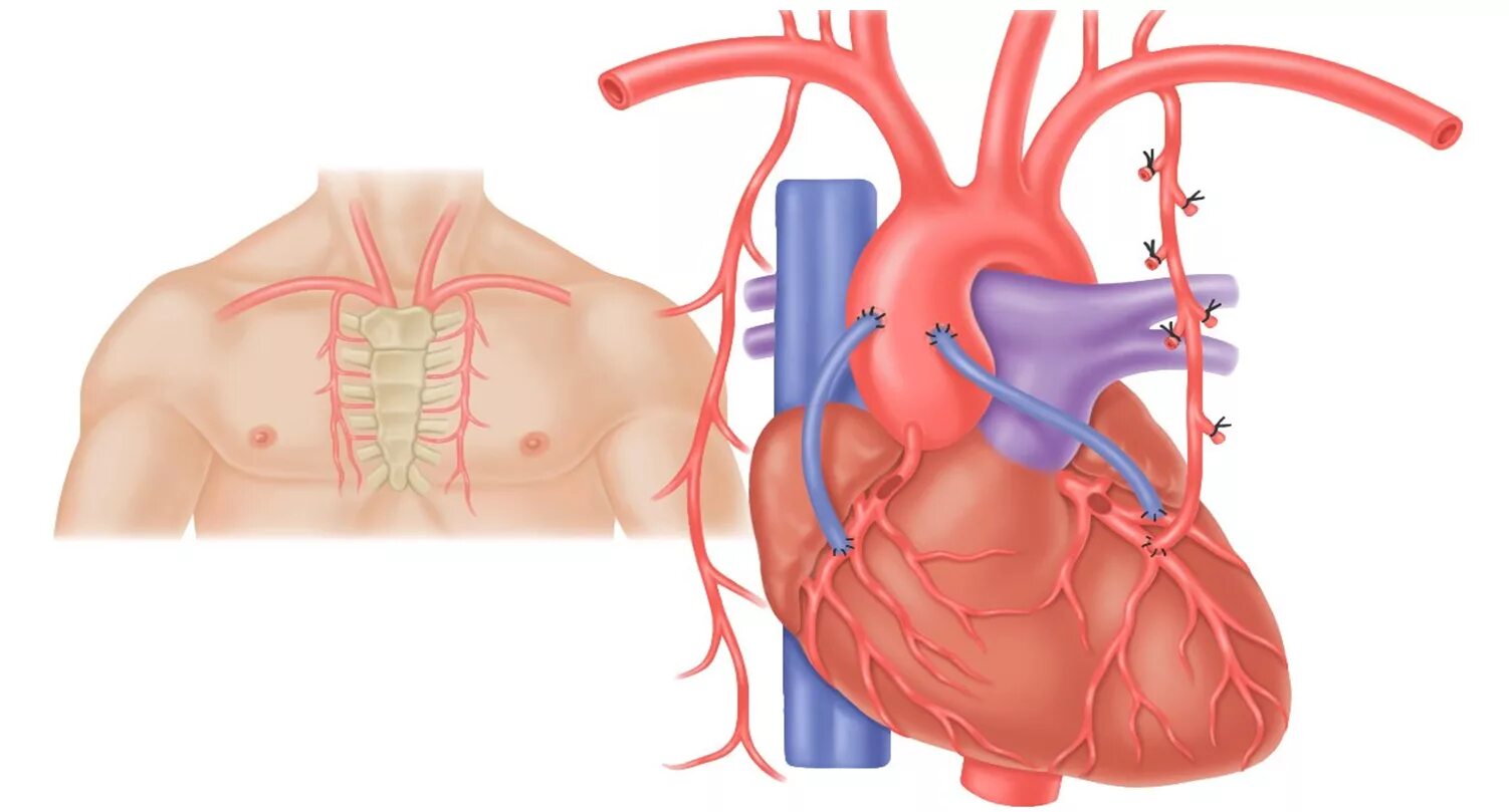 Операция замена сосудов. Аортокоронарное шунтирование сосудов. Аортокоронарное шунтирование (АКШ). Шунтирование артерий сердца. Операция шунтирование сосудов сердца.