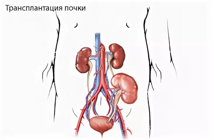 Почечный трансплантат