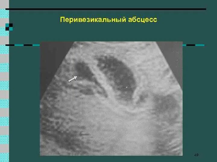 Отек желчного пузыря. Перивезикальный абсцесс желчного пузыря. Перивезикальный инфильтрат желчного. Перипузырный инфильтрат.