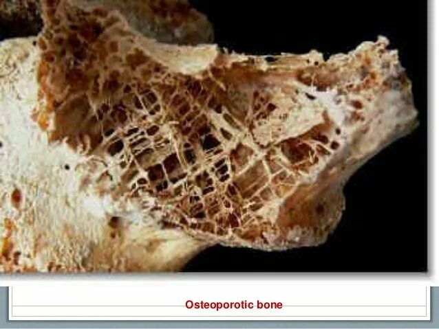 Как называется разрушение костей. Сенильный остеопороз. Остеопороз риск переломов. Как называется разрушение костей. Заболевание костей остеопороз.