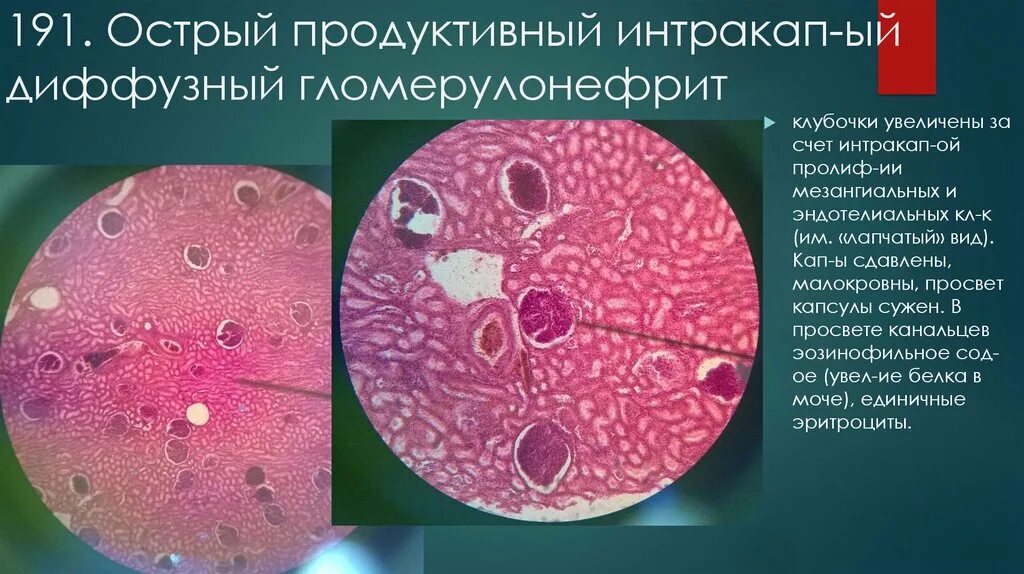 Гломерулонефрит эритроциты. Лапчатые клубочки почек. гломерулонефрит клубочек. лапчатые клубочки почек микропрепарат. острый диффузный гломерулонефрит.