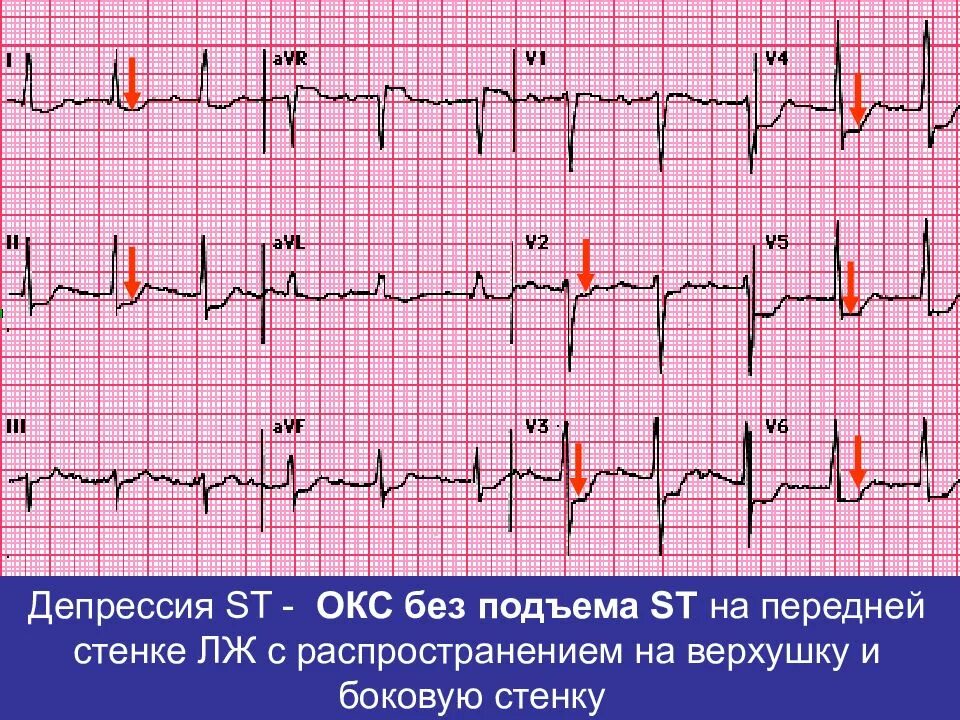 St ишемия. ЭКГ Окс без подъема сегмента St. Острый коронарный синдром без подъема сегмента St ЭКГ. ЭКГ острый коронарный синдром инфаркт миокарда. Подъем сегмента St в AVR на ЭКГ.