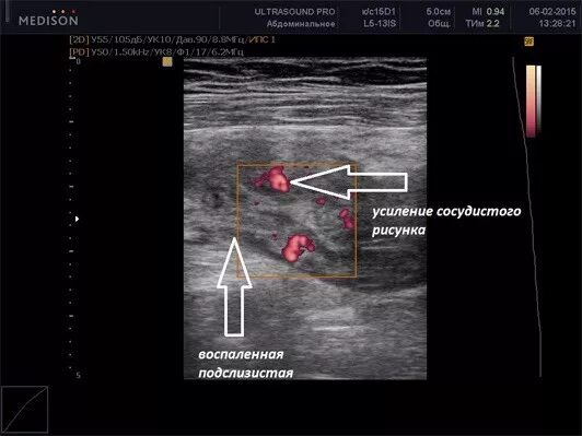 Узи кишечника как делается. Трансабдоминальное узи кишечника. Узи кишечника как делается. Узи кишечника как делается. Ультразвуковое исследование (узи) кишечника.
