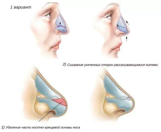 Почему синий нос. Ринопластика носа Крылья носа. Безоперационная ринопластика хряща носа. Приподнятие кончика носа.