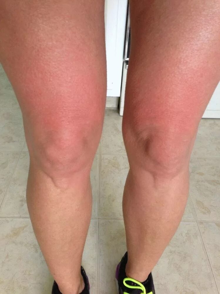 Препателлярный бурсит. Мышечный отек. Мышечный отек. Воспаление мышц миозит. Тромбоз глубоких вен нижних конечностей.