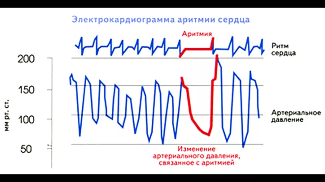 Аритмия и гипертония. Аритмия. Аритмия давление и пульс. Нарушение ритма сердца кардиограмма. Сердечная аритмия ЭКГ.