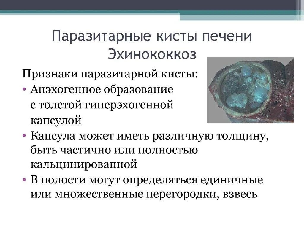 Киста печени причины возникновения у женщин. Паразитарные и паразитарные кисты печени. Паразитнач киста печени.