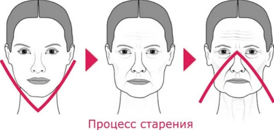 Возрастные изменения овала лица. Треугольник старения. Птоз овала лица. Опущенный овал лица.