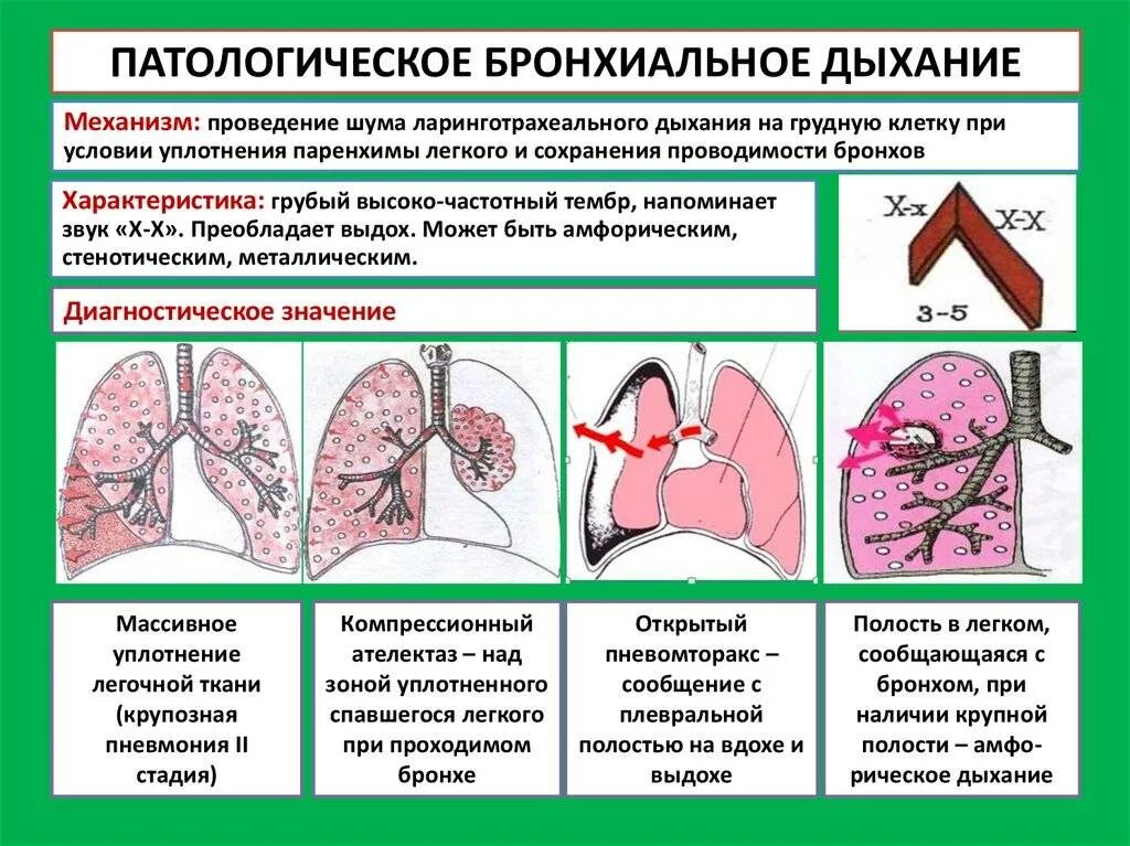 Инфильтрационное бронхиальное дыхание. Тип дыхания при бронхите. Разновидности патологического бронхиального дыхания. Механизм дыхательной недостаточности при пневмонии:.