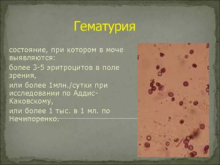 Макрогематурия эритроциты в моче. Эритроциты в поле зрения в моче. Микрогематурия анализ мочи. Эритроциты в моче 2 3 в поле зрения. Появление эритроцитов в моче