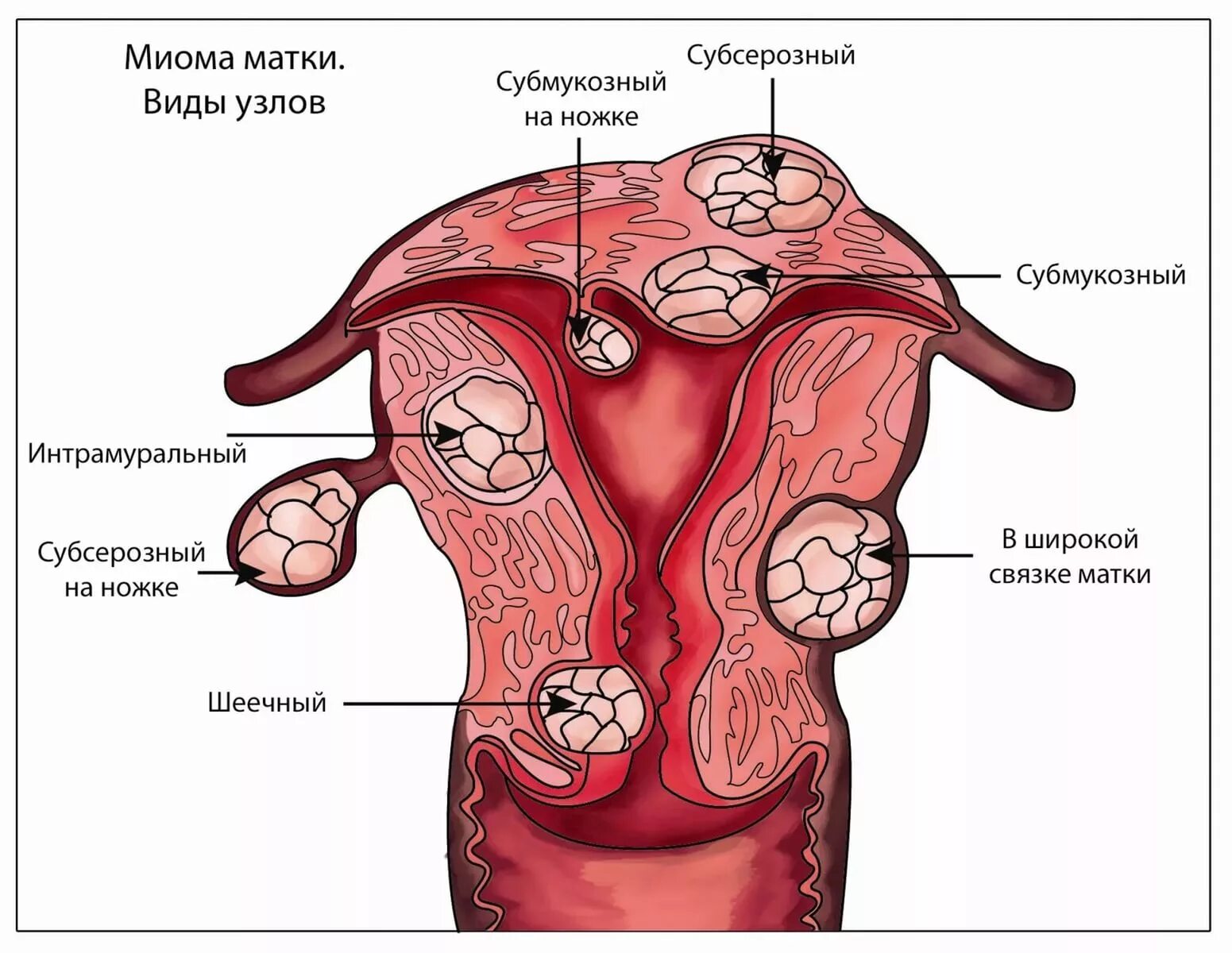 Причины появления миом. Множественная субсерозная миома матки. Миоматозные узлы в матке. Субсерозная лейомиома матки. Миоматозные узлы расположение.