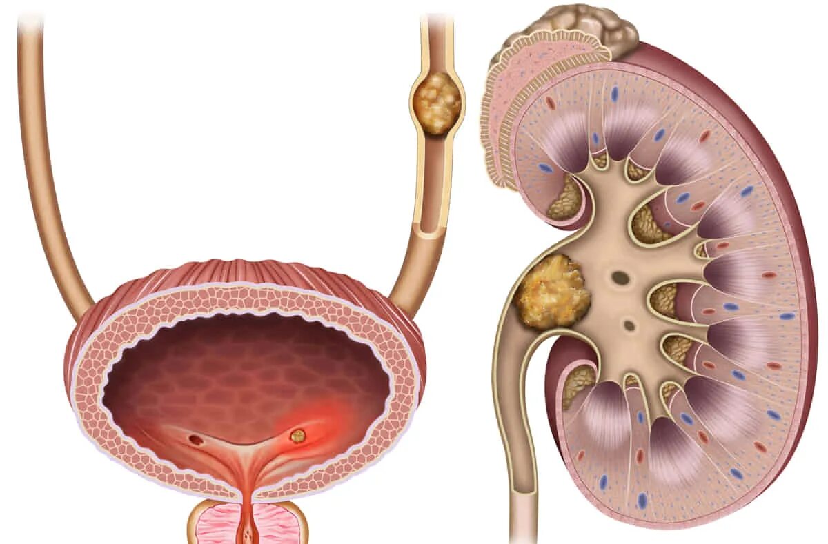 Почечная колика при мочекаменной болезни. Мочекаменная болезнь урология камни мочеточника. Локализация камней в почках.