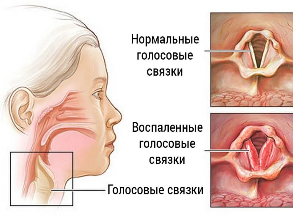 Щекочет гортань