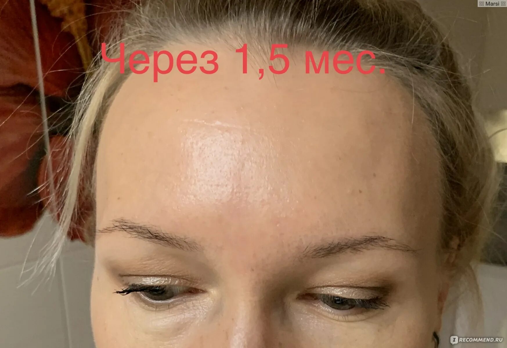 Шишки после уколов ботокса. Ботокс для бровей. шишка на лбу после ботокса. шишка на лбу после уколов ботокса. эффект ботокса между бровей.
